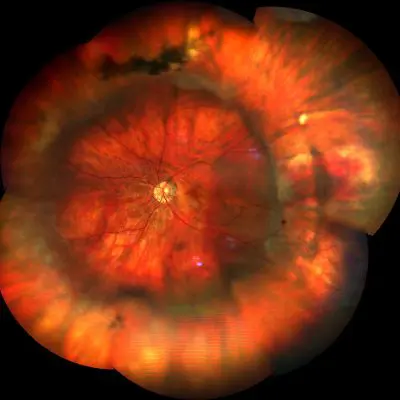 Postoperative retinal detachment cerclage