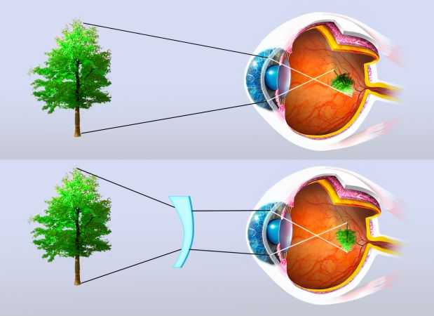 Rappresentazione grafica della correzione tramite lente dell'astigmatismo
