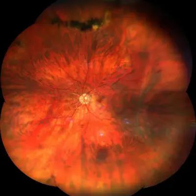Grande distacco di retina