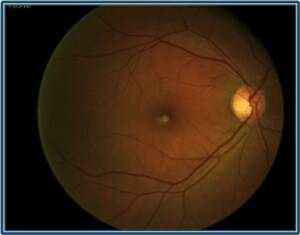 Neuropatia ottica ereditaria di Leber (LHON): dallo studio in fase 3 una speranza inaspettata. 1 Immagine di una neuropatia di leber