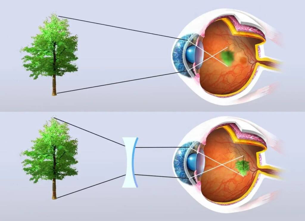 Rappresentazione grafica della correzione tramite lente della miopia