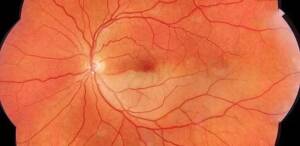 Immagine di una occlusione arteriosa retinica