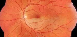 Angiografia con fluoresceina (FA) e con verde indocianina (ICGA) 16 Immagine di una occlusione arteriosa retinica