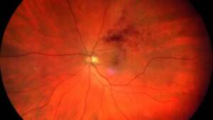 Angiografia con fluoresceina (FA) e con verde indocianina (ICGA) 15 Immagine di una occlusione venosa retinica