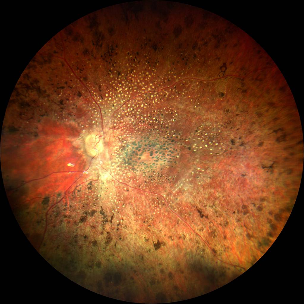 fundus