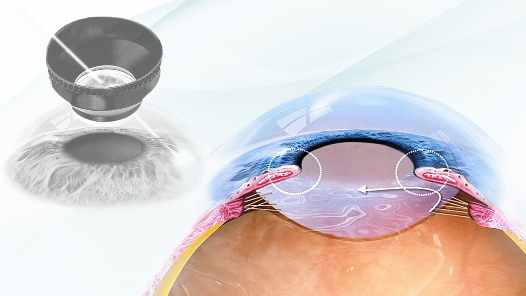 Glaucoma ad angolo aperto con iridotomia