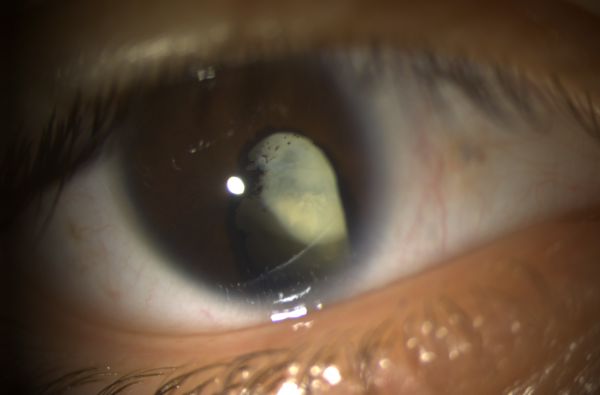 Immagine di occhio con cataratta congenita e coloboma