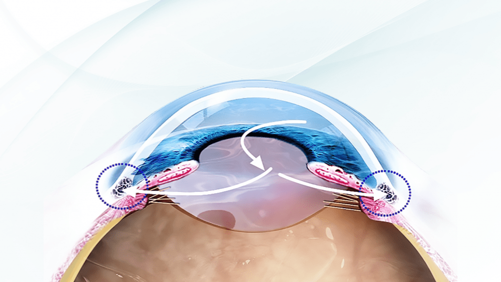 Glaucoma ad angolo chiuso 1 Immagine grafica rappresentante il glaucoma ad angolo chiuso