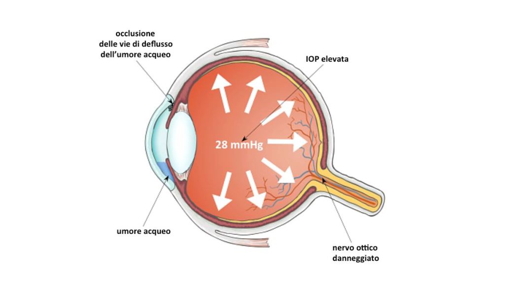 glaucoma stiledivita cusumano