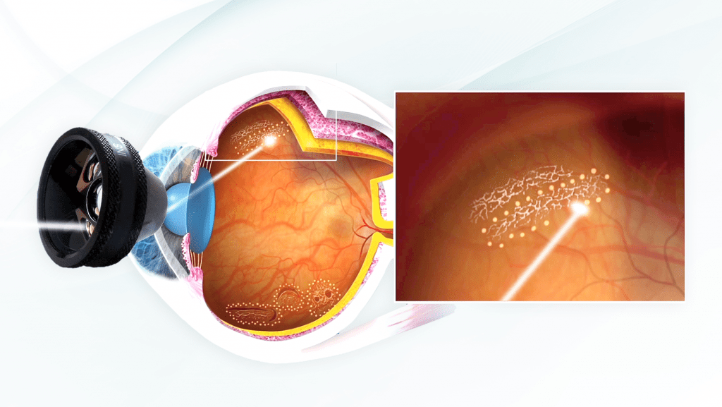Degenerazioni retiniche periferiche 2 Degenerazioni retiniche periferiche