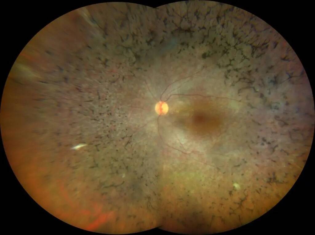 Immagine di una retinite pigmentosa