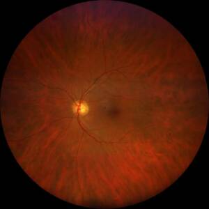 Angiografia con fluoresceina (FA) e con verde indocianina (ICGA) 14 Immagine di una retinopatia diabetica non proliferante