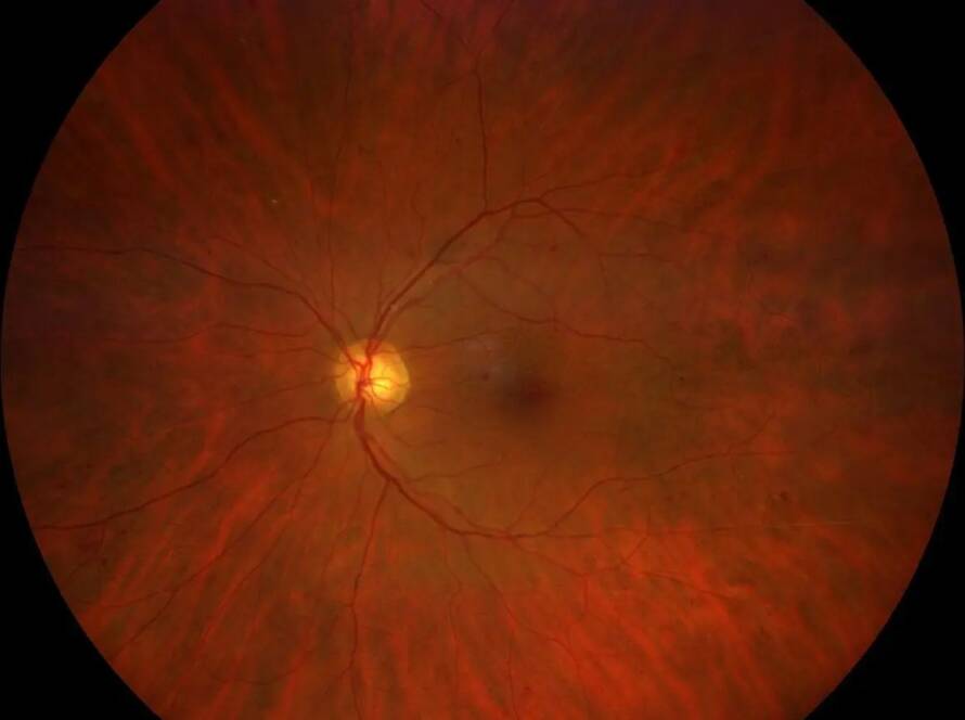 Immagine di una retinopatia diabetica non proliferante