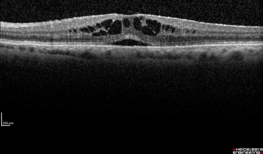 News 14 Immagine di un edema maculare cistoide