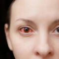 Occhi rossi: principali cause, sintomi e trattamenti