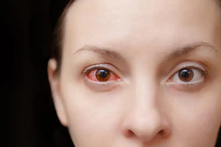 Immagine di donna con un occhio rosso