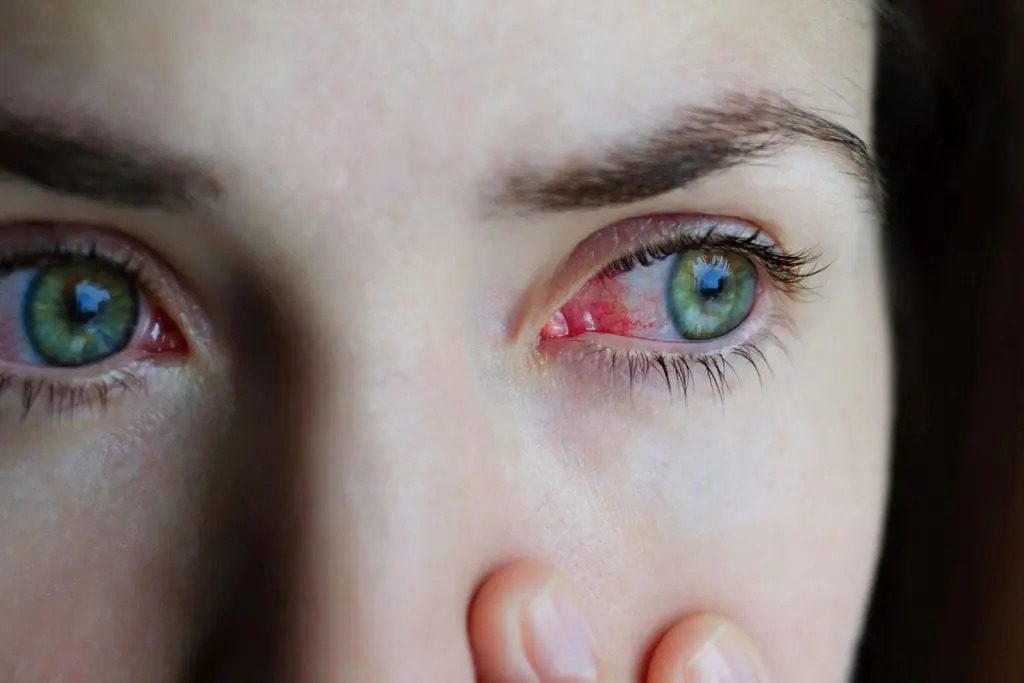 Immagine di donna con occhi rossi