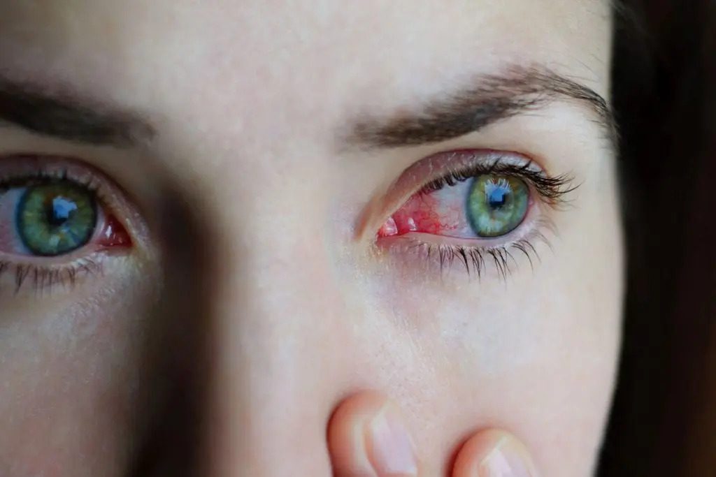 5 raisons qui peuvent expliquer les yeux rouge et quelques solutions