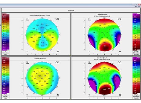 Astigmatismo: vedo aloni intorno le luci, mi danno fastidio i fari delle macchine, li vedo allungati. 2 Risultato di un esame effettuato dalla Pentacam