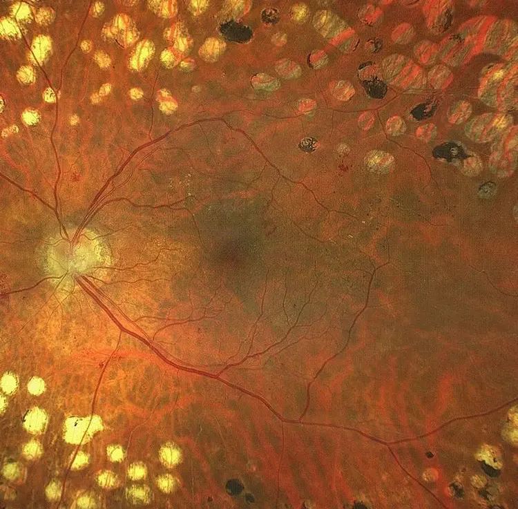 Immagine di una retinopatia diabetica