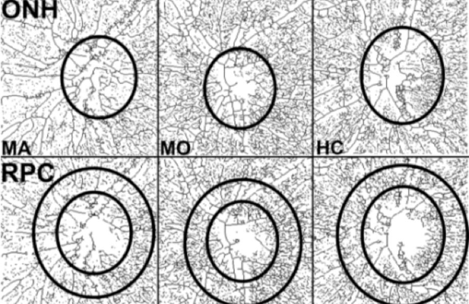 Mal di Testa: pericolo per gli occhi? 5 Immagine di una scansione del nervo ottico