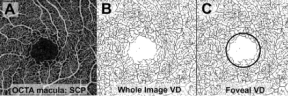 Immagine di scansioni maculari per la misurazione della densità dei vasi